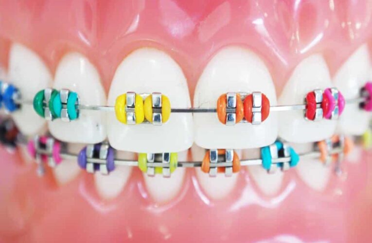 Orthodontic Braces: Metal, Ceramic, Clear or Lingual?