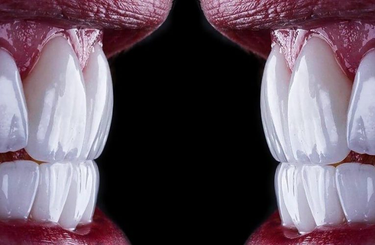 Advantages of Composite Veneers in Singapore for Cosmetic Dentistry